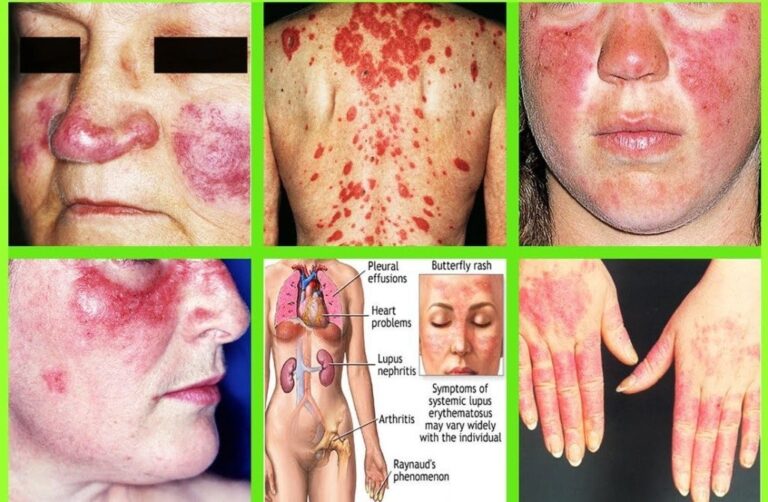 Paket Terapi untuk Lupus