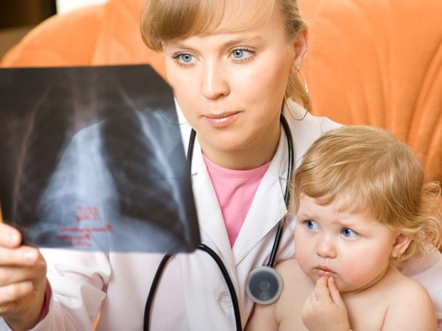 Pneumonia pada Anak Ternyata Juga Bisa Diatasi dengan Minyak Kelapa