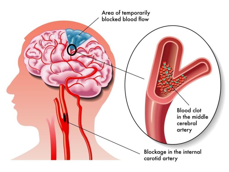 Paket Terapi untuk Stroke