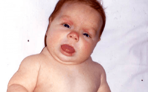 Waspadai Hipotiroid Pada Bayi