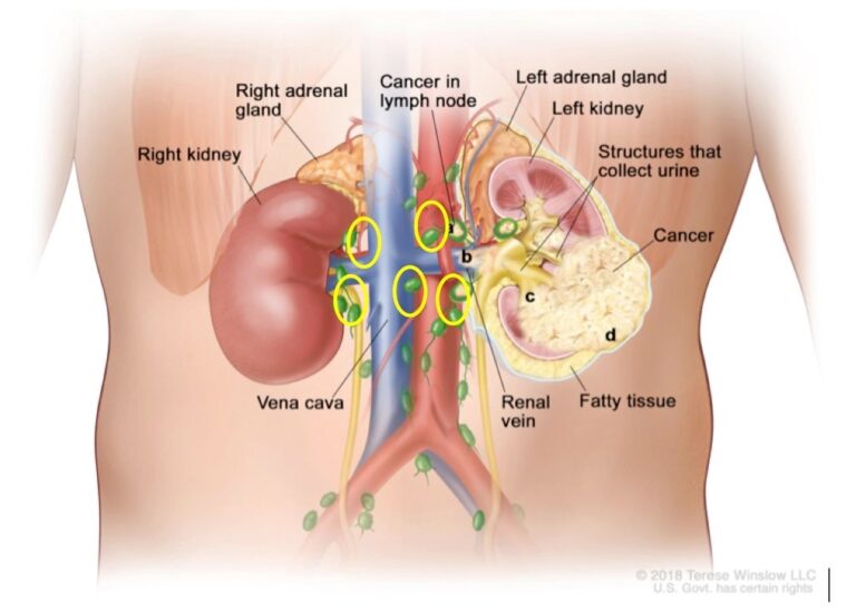 Pengobatan Tumor Wilms Secara Alami
