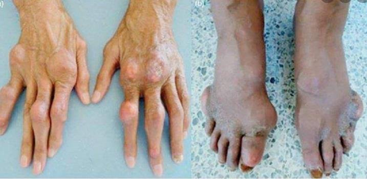 Aplikasi Praktis Terapi VCO, Madu, dan Nutrisi untuk Asam Urat dan Rematik
