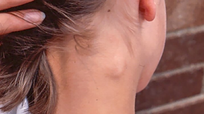 Dianggap Sepele, Lipoma Bisa Berakibat Fatal