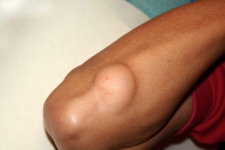 Lipoma: Gejala, Penyebab & Pengobatan