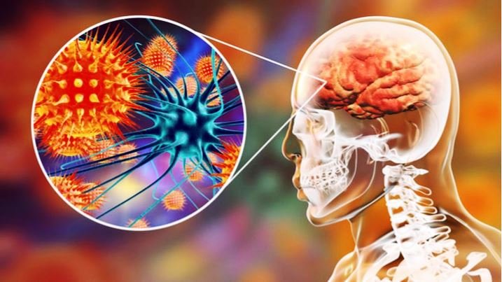 Pengobatan Meningitis dengan Minyak Kelapa Murni Pada Pasien HIV