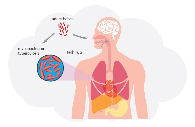 Aplikasi Praktis Terapi VCO, Madu, dan Nutrisi untuk TBC