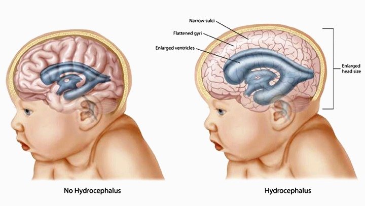 Terapi Lebah Hilangkan Kejang-Kejang Pasca Operasi Hydrocephallus
