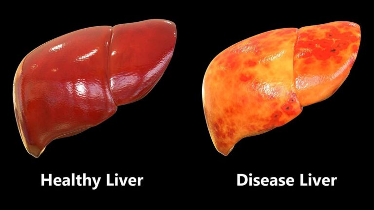 Minyak Kelapa Murni Meningkatkan Kadar Antioksidan, Baik untuk Penderita Gangguan Liver