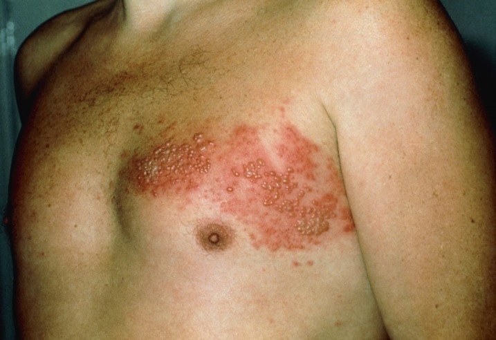 Cara Menyembuhkan Herpes yang Mengganggu