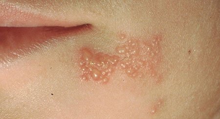Hati-Hati, Herpes Simplex Virus (HSV) Bisa Menyebabkan Kematian!