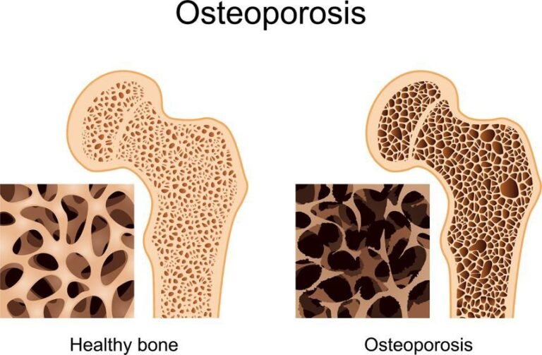 Osteoporosis Bukanlah Penyakit Kekurangan Kalsium!