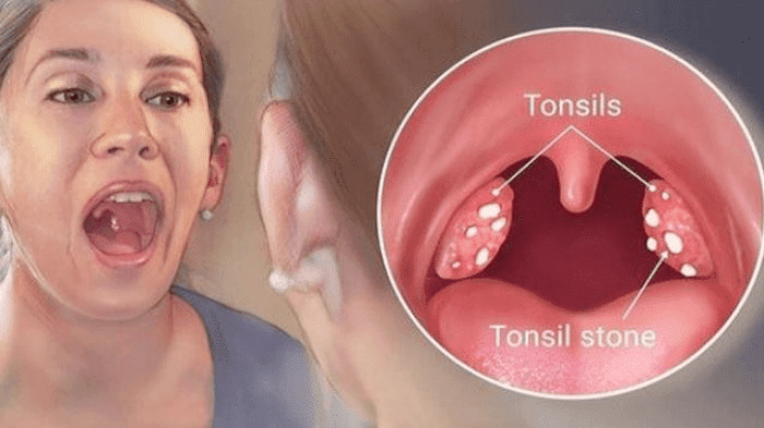 Kiat Praktis & Cepat Atasi Sakit Amandel Tanpa Operasi