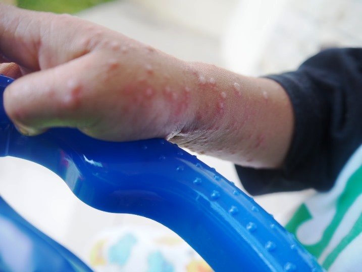 Flu Singapura, Mengancam Nyawa Anak Jika Dianggap Sepele