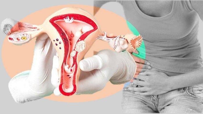 8 Ciri-ciri Kista Ovarium, Kondisi Umum yang Sering Dialami Wanita